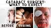 What To Expect Before During And After Cataract Surgery